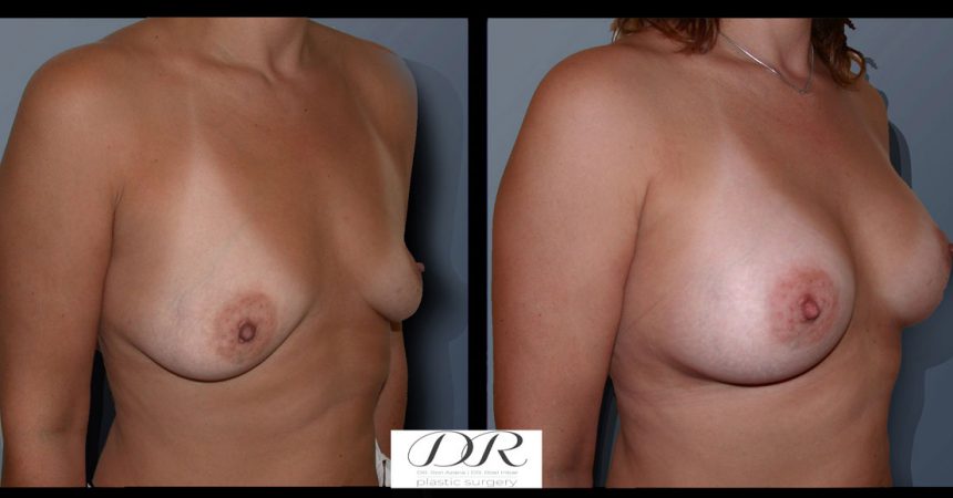 breast-asymmetry-1B