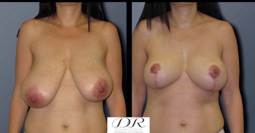 breast-asymmetry-2A