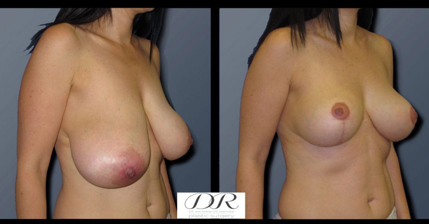 breast-asymmetry-2B