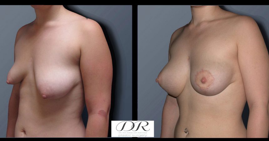 breast-asymmetry-3B