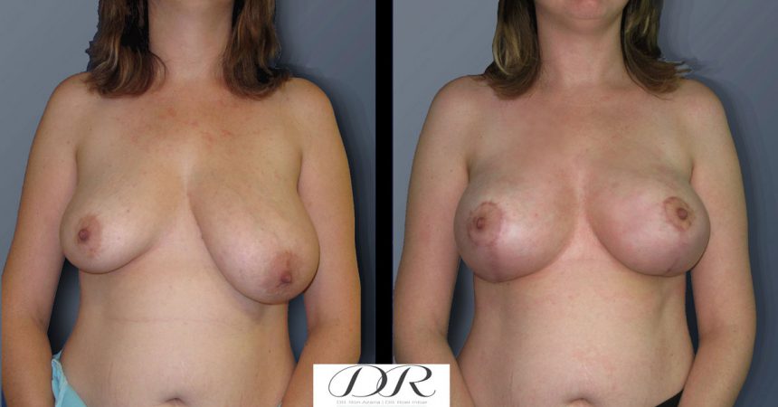breast-asymmetry-4A
