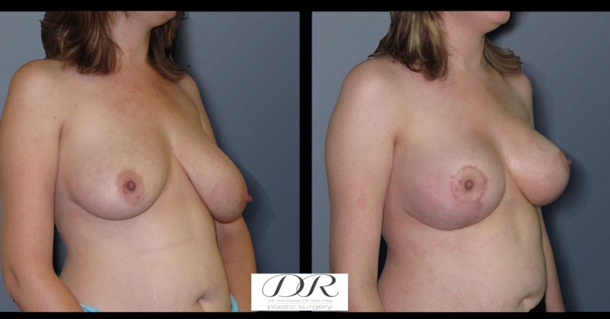 breast-asymmetry-4B