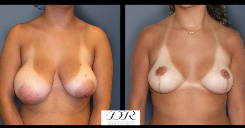 breast-asymmetry-5A