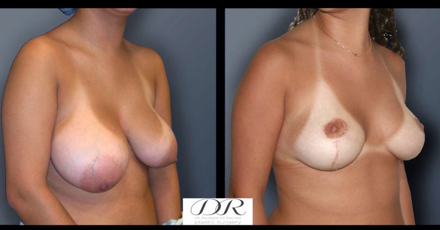 breast-asymmetry-5B