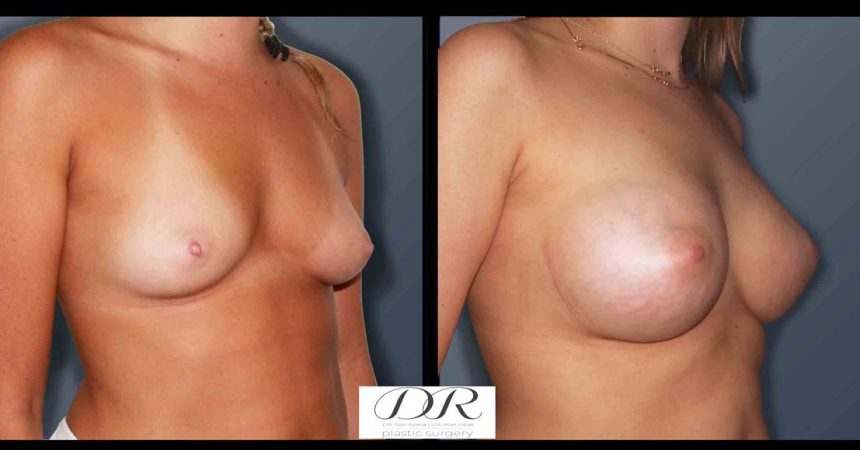 breast-asymmetry-6B