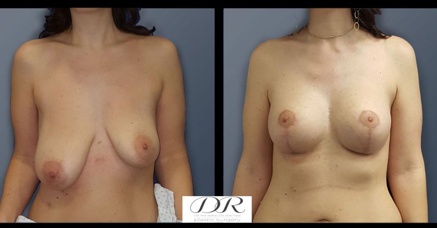 breast-asymmetry-7A