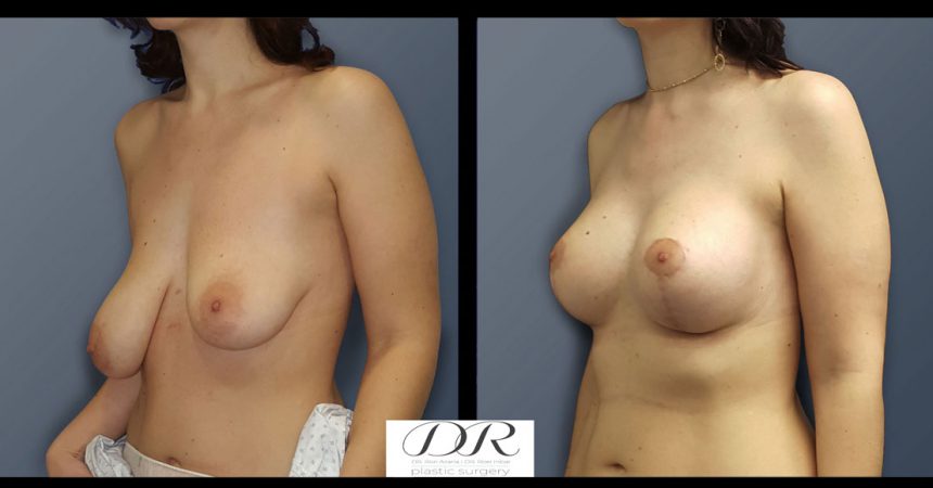 breast-asymmetry-7B