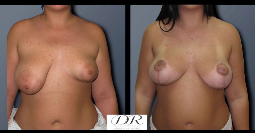 breast-asymmetry-8A
