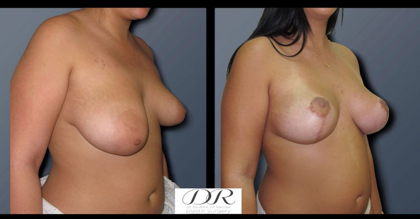 breast-asymmetry-8B