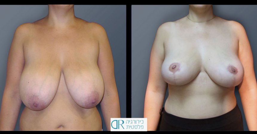 breast-reducton-3A