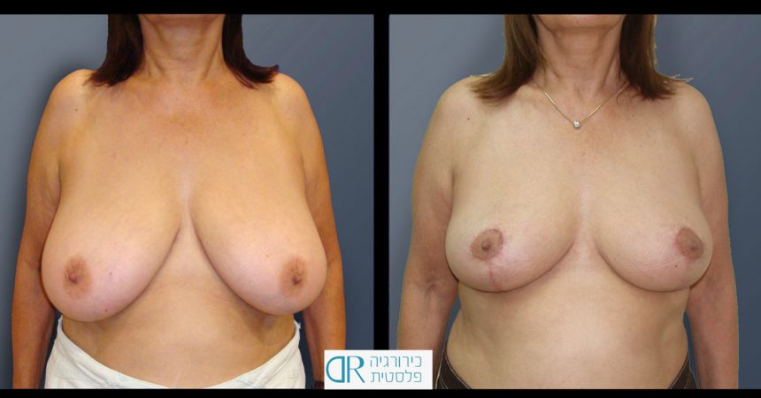 breast-reducton-4A