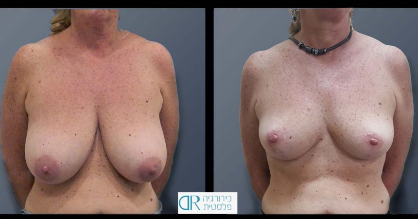 breast-reducton-6A