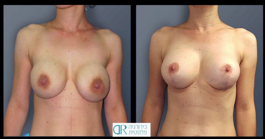 exchange-breast-implants-1A