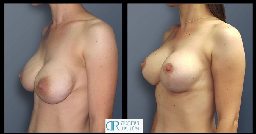 exchange-breast-implants-1B