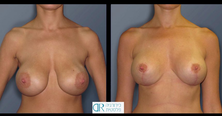 exchange-breast-implants-2A