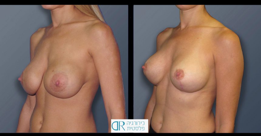 exchange-breast-implants-2B