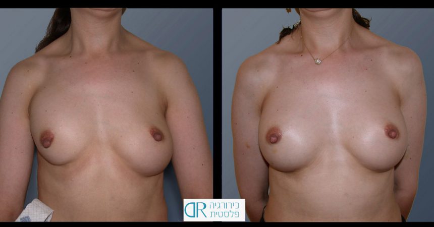 exchange-breast-implants-3A