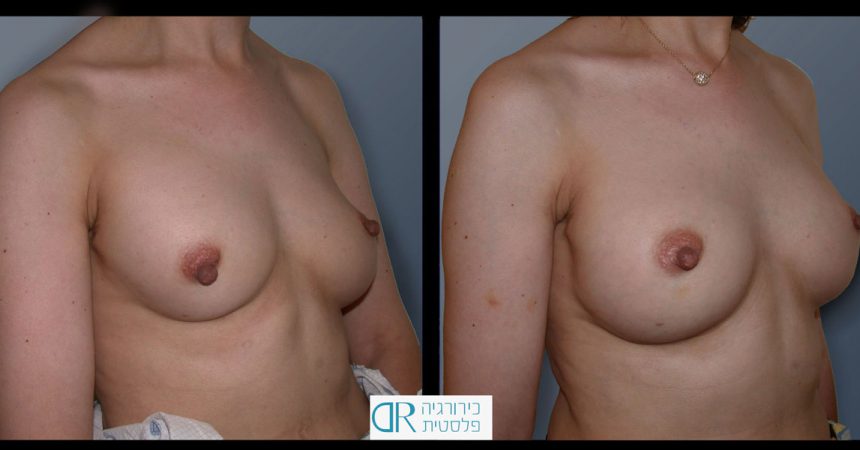 exchange-breast-implants-3B