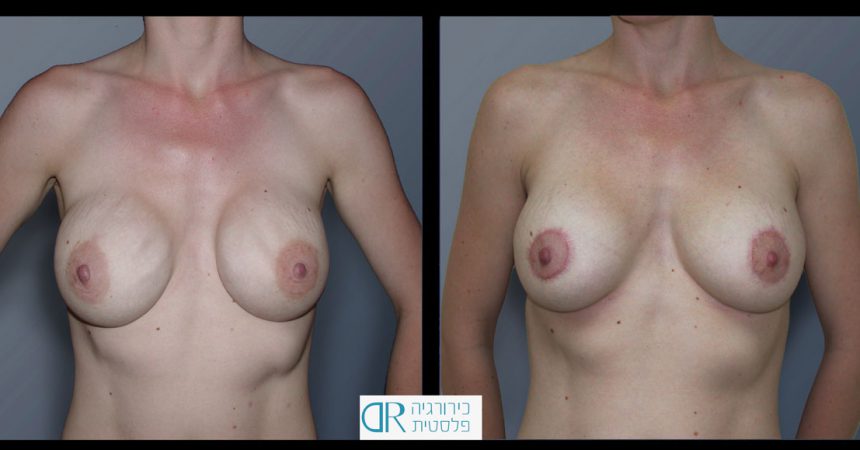 exchange-breast-implants-4A