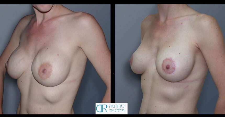 exchange-breast-implants-4B
