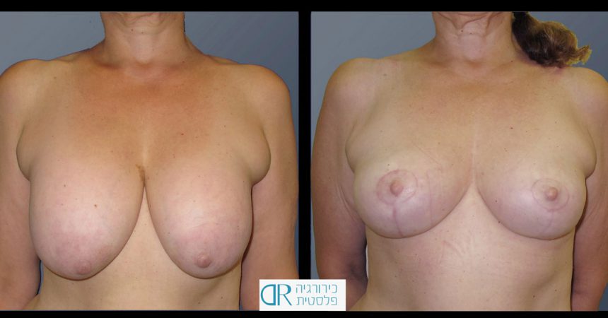 exchange-breast-implants-5A