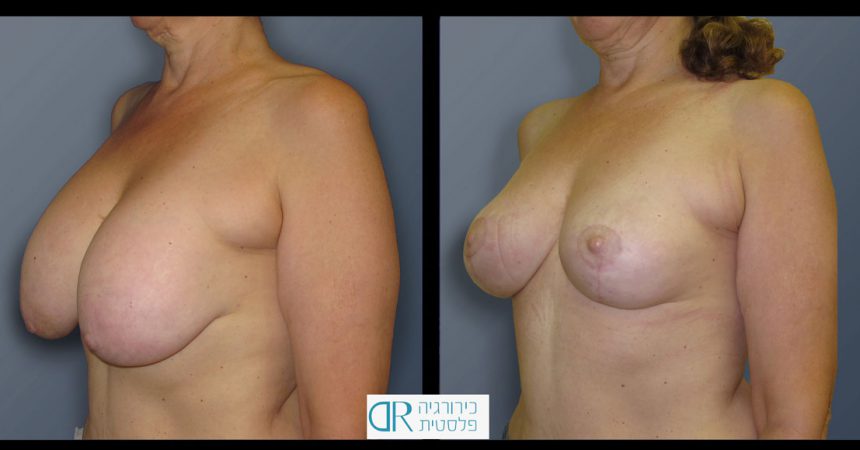 exchange-breast-implants-5B