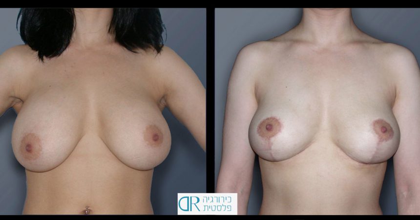 removal-breast-implants-1A
