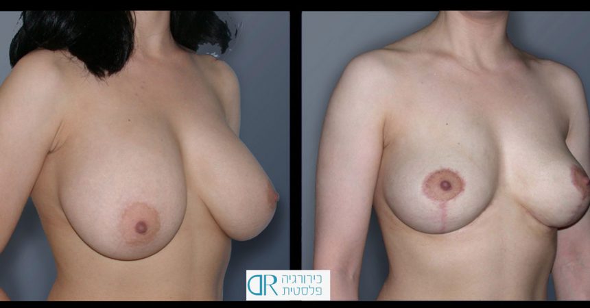 removal-breast-implants-1B