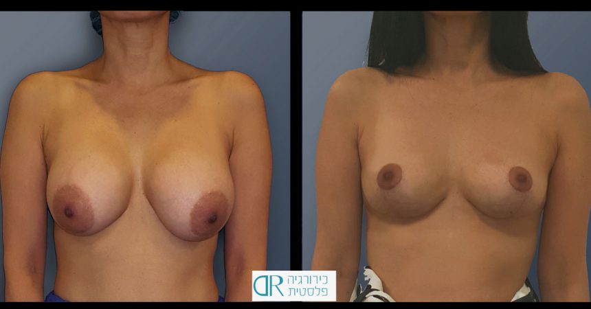 removal-breast-implants-2A