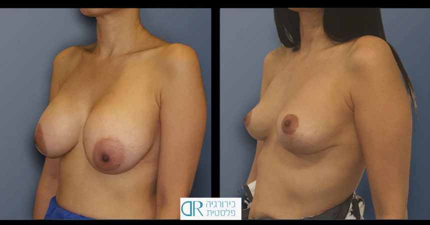 removal-breast-implants-2B