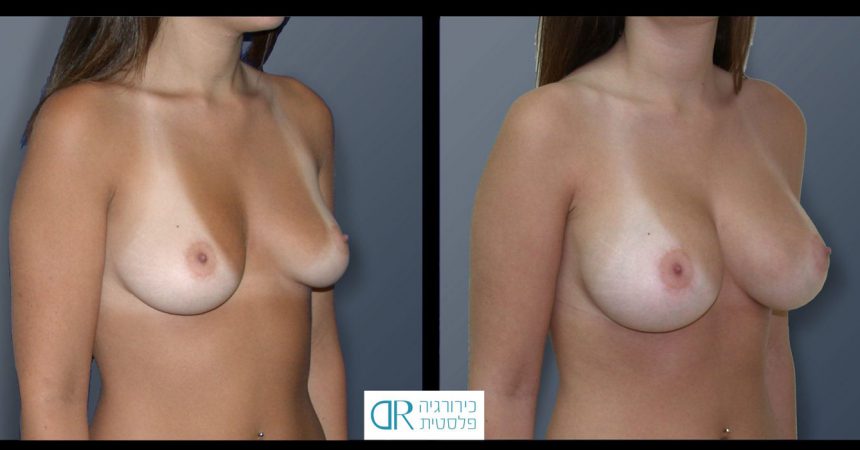 breast-asymmetry-9B
