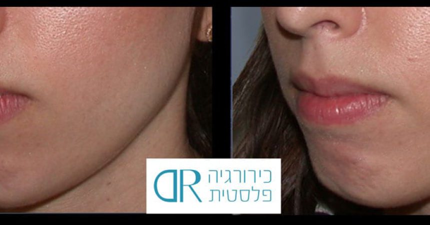 lip-augmentation-2B
