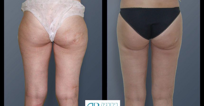 liposction-24-yo-female-thighs-1B
