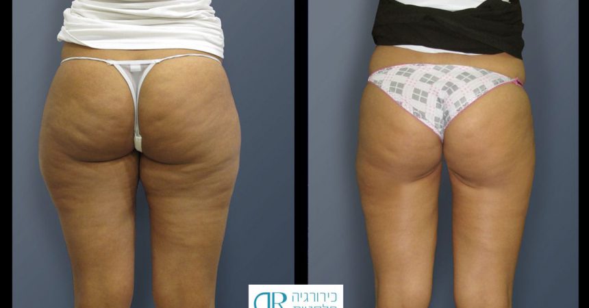 liposction-26-yo-female-thighs-1B