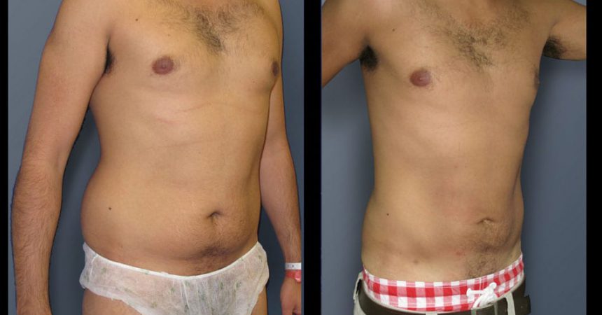 liposction-32-yo-male-abdomen-1B