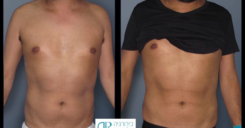 liposction-male-abdomen-1A