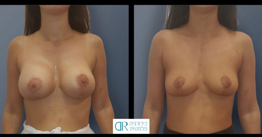 removal-breast-implants-10A
