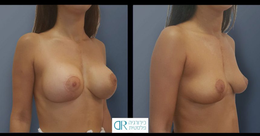 removal-breast-implants-10B