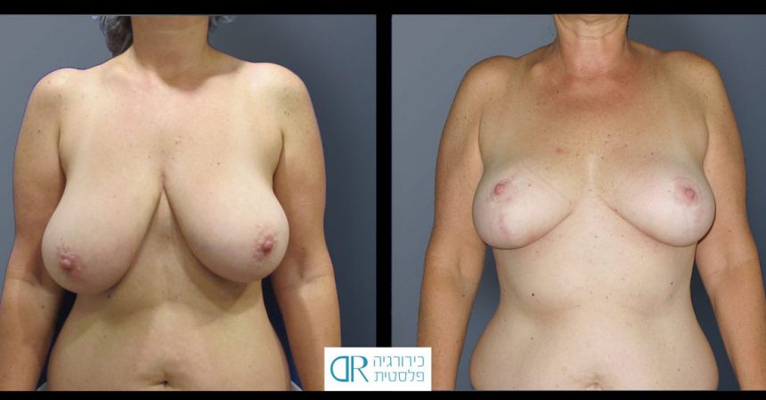 breast-reduction-10A