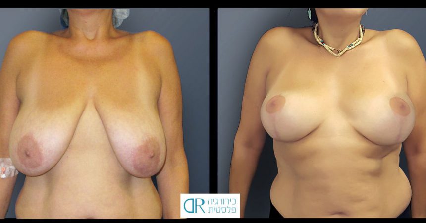 breast-reduction-11A