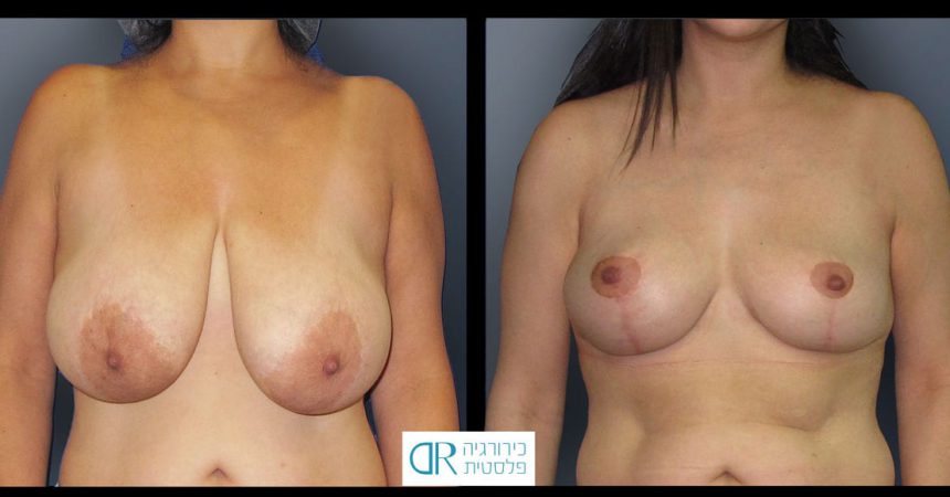 breast-reduction-13A