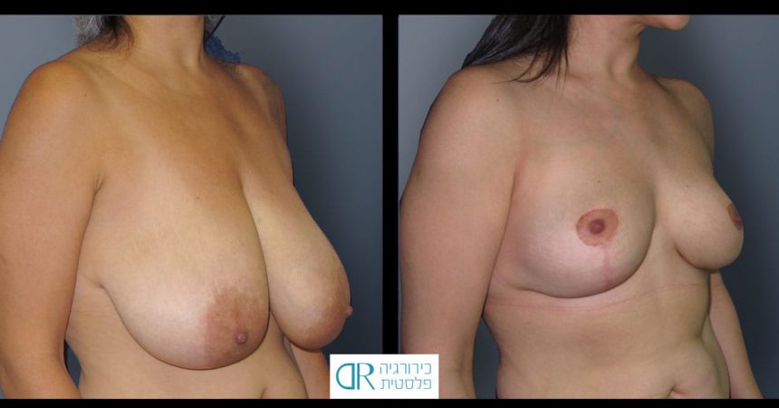 breast-reduction-13B