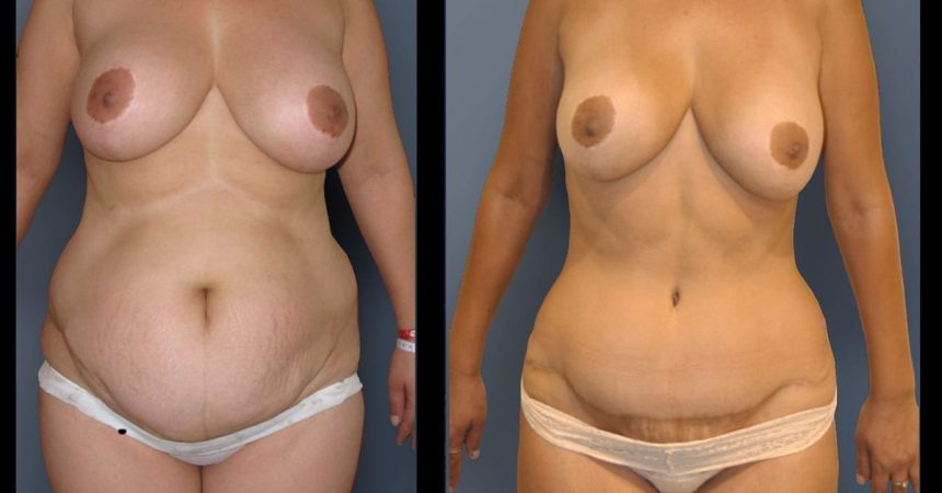 POVH-repair-and-abdominoplasty A
