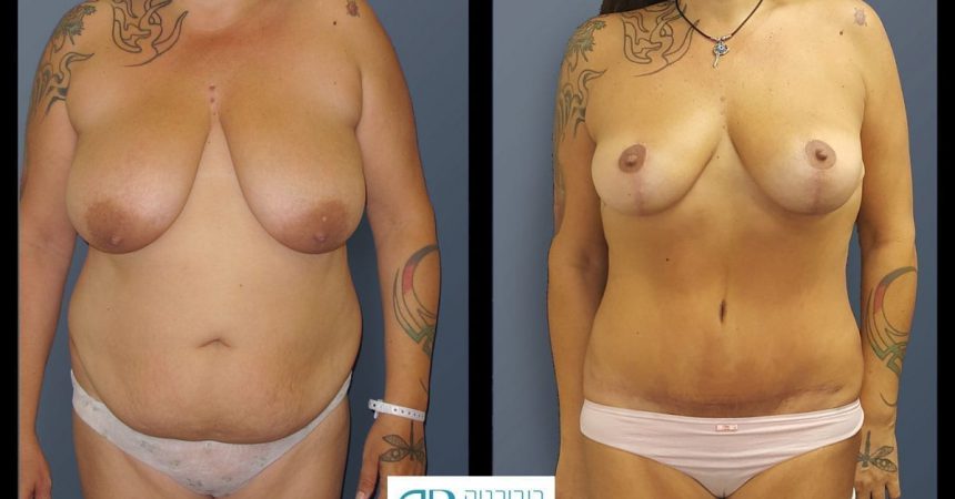 breast-mpx-and-abdomino-and-lipofilling--4A