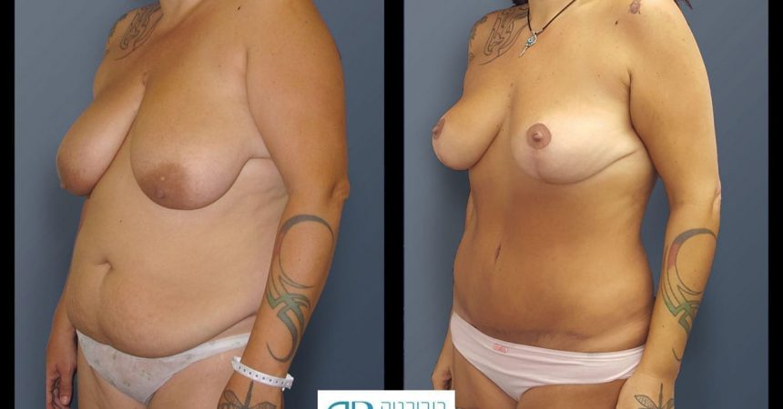 breast-mpx-and-abdomino-and-lipofilling--4B