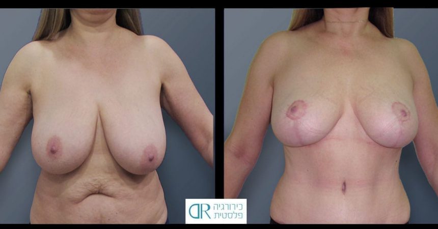 breast-reduction-14A