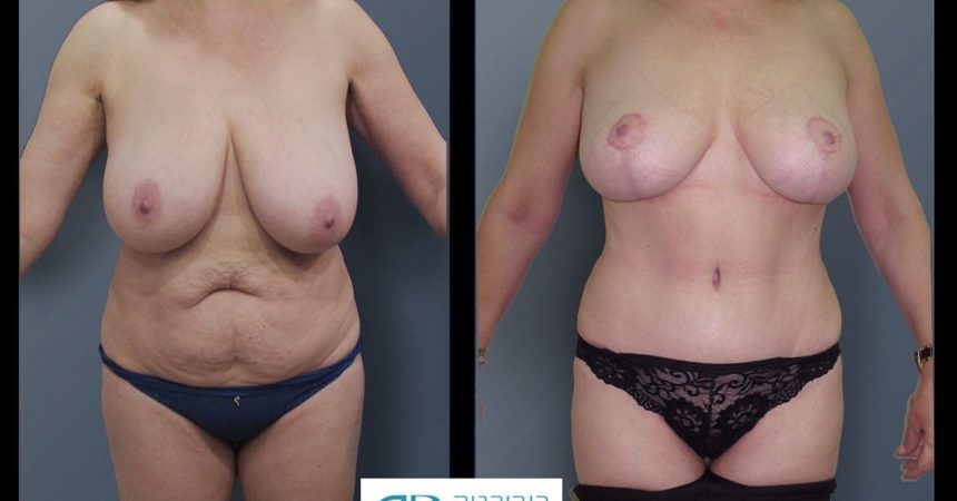 breast-reduction-and-abdomen-3A