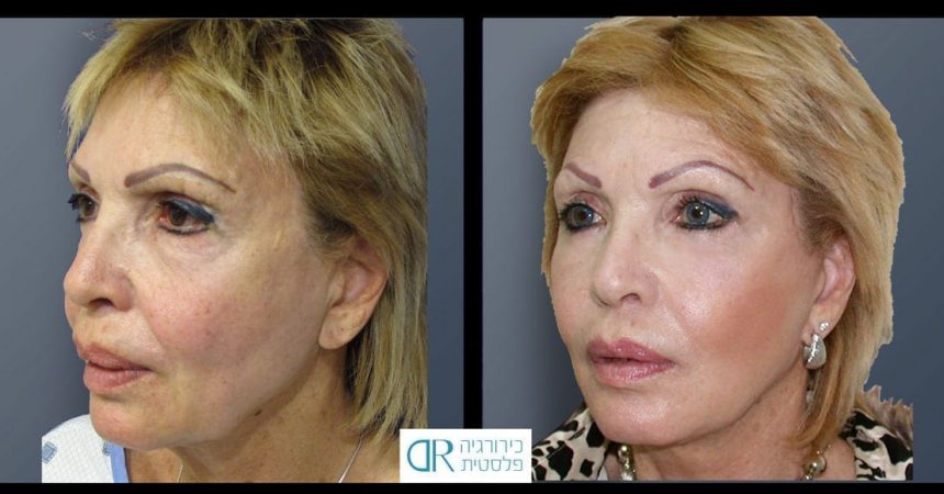 face-lift-and-chemical-peeling-1B