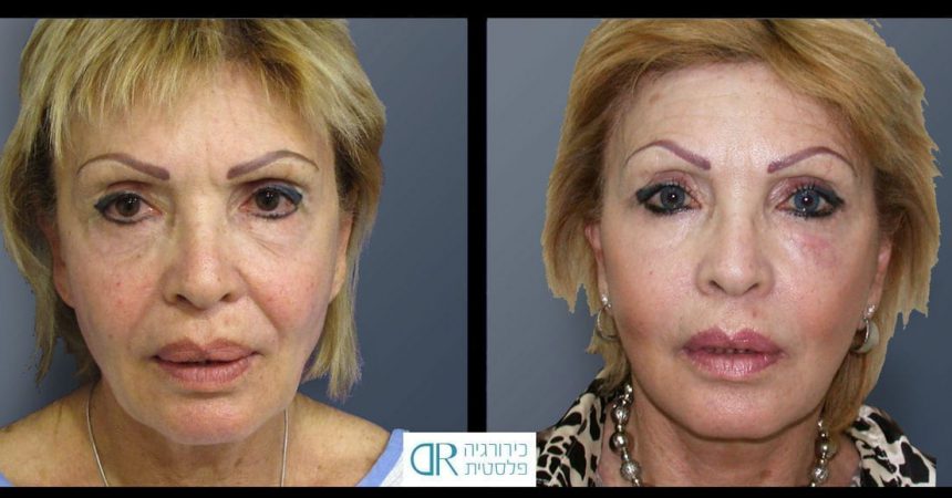 face-lift-and-chemical-peeling