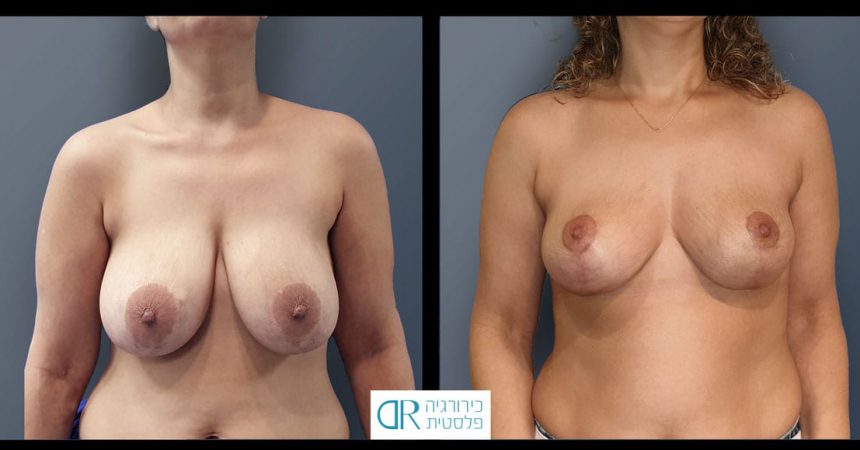 removal-breast-implants-11A-re-mastopexy